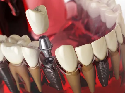 Dental Implant