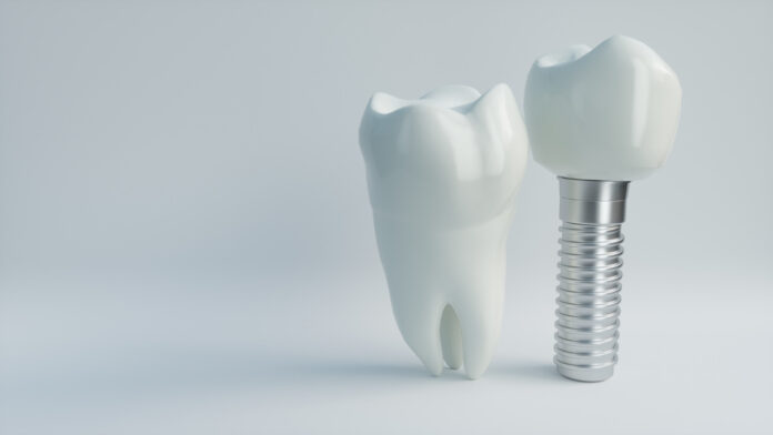 dental implants alexandria